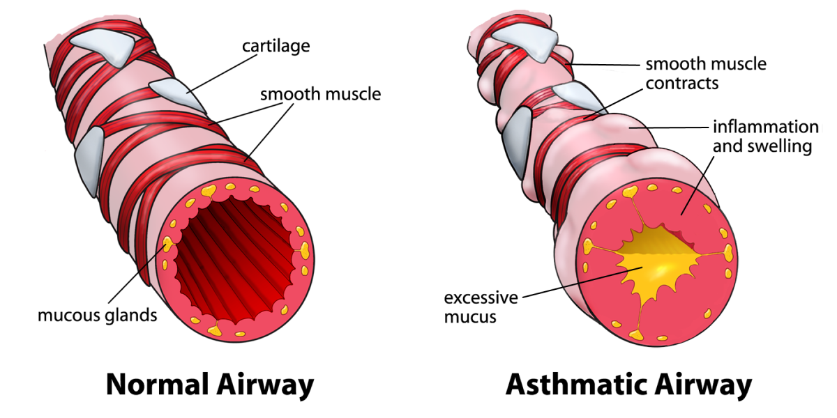 Drawing of Normal Airway and Airway during an Asthma Attack