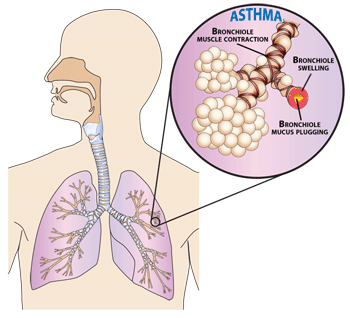 Diagram showing the effect of an asthma attack